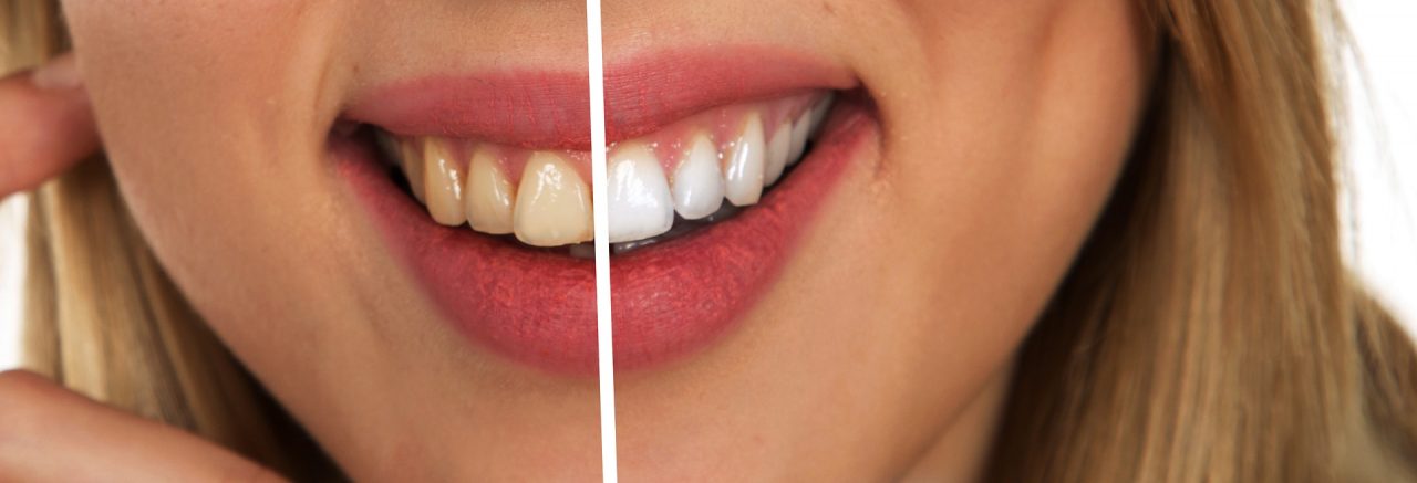 tooth-2414909_1920-1280x437.jpg